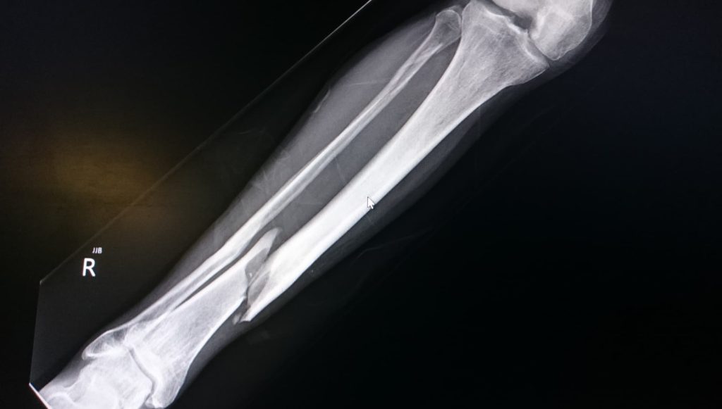 birth injuries examples
